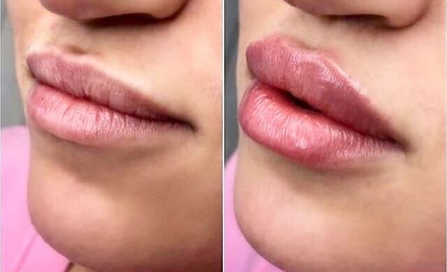 Ефект на уголемяване на устните с терапията по поставяне на безиглен хиалурон за устни
