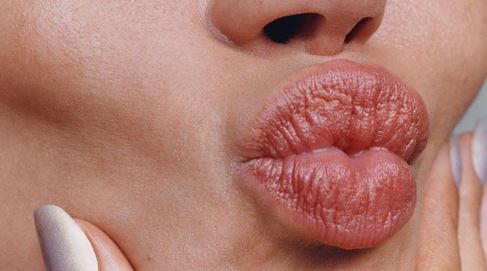 Естетичен ефект след процедура за уголемяване на устните чрез поставяне на безиглен хиалурон за устни
